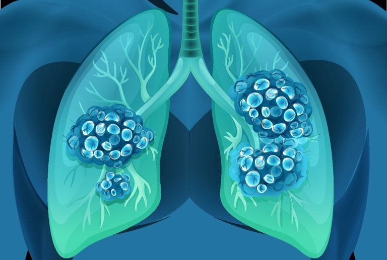 Have You Heard About NTM Lung Disease