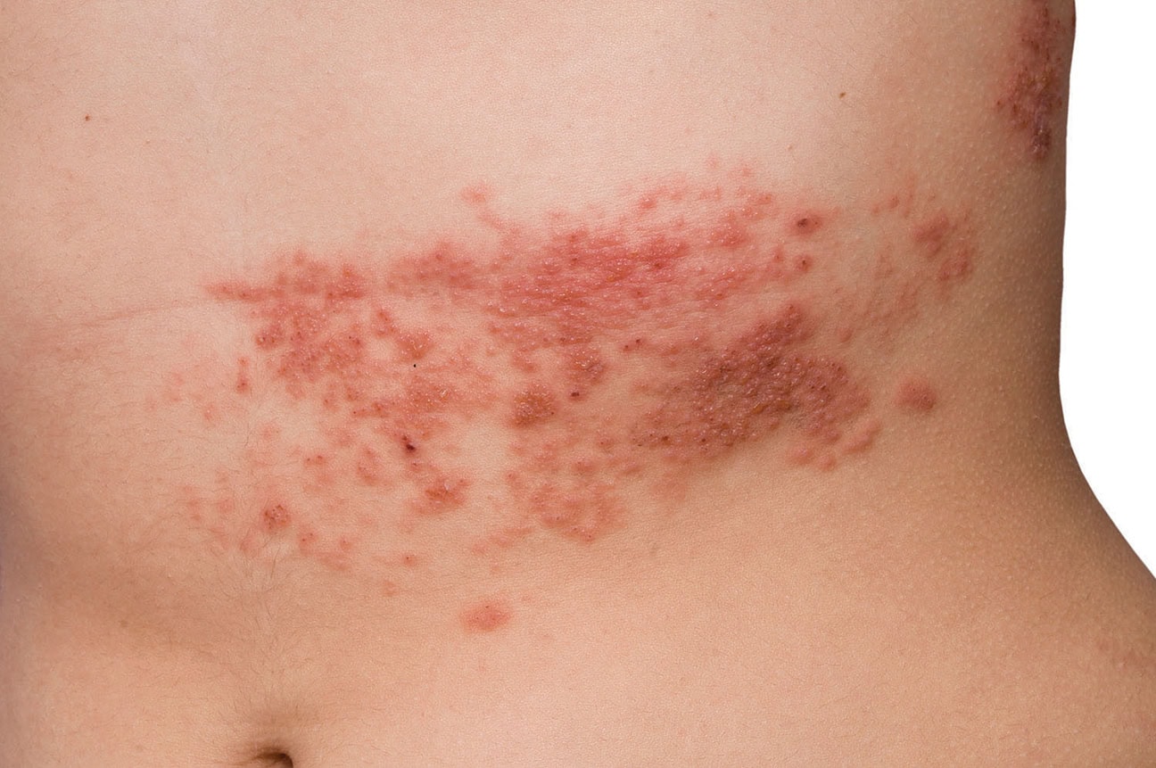 Shingles Can Hit Younger Than You Think. The Vaccine Can Prevent The Painful Illness